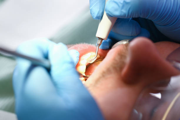 Best Emergency Dental Care for Broken or Chipped Teeth in Seven Hills, OH